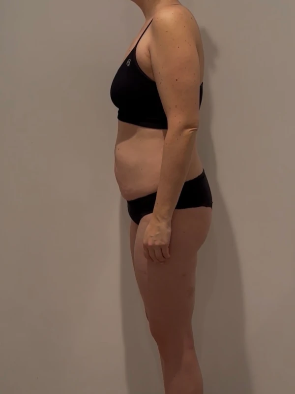 Milena K. – Nachher